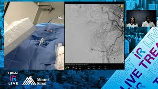 Transradial Prostate Artery Embolization using nBCA Glue for Benign Prostatic Hyperplasia BPH [upl. by Eerahc]