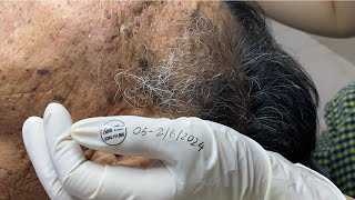 Latest acne treatment for 93 year old gentleman 2024 part 5 [upl. by Tarrsus71]