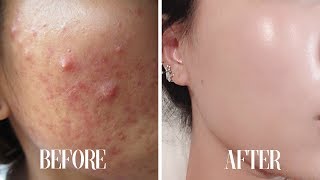 Get CLEAR SKIN subliminal  Get rid of acne in 10 minutes [upl. by Enert]