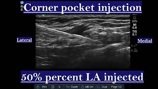 Supraclavicular Approach to Brachial Plexus block [upl. by Rame816]