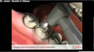 Esthetics And Restorative  Conservative Air Abrasion For Cavity Restoration  Ottawa Dentist [upl. by Fatimah513]