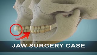 Corrective Jaw Surgery  Orthognathic Surgery  Curveia Dental Animation [upl. by Irt]