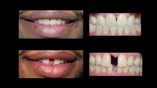 Invisaign for Teeth Gap Treatment at Cosmetic Dental Associates [upl. by Mikey836]