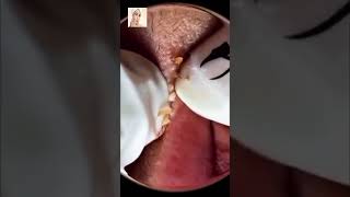 Blackheads Removal  Acne Treatment and Very Satisfying Satisfying Pimple pop blackheads [upl. by Aiykan173]