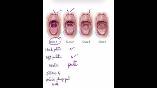 Modified Mallampati classification Anaesthesia [upl. by Ultann]