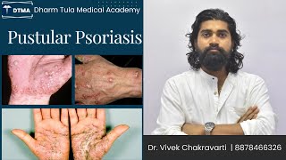 Pustular psoriasis  Psoriasis  Skin Disease  Skin psoriasis psoriasiscure psoriasissolution [upl. by Hgielanna170]