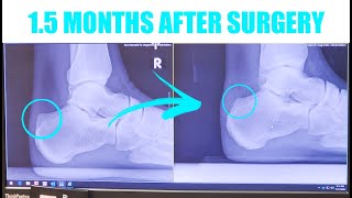 Haglunds Surgery Recovery  15 Months After Surgery [upl. by Pettit]