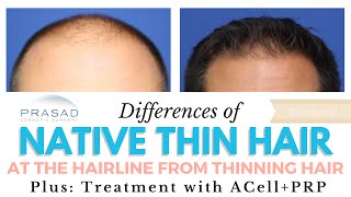 Differences of Naturally Thin Hair and Thinning Hair and Treatment to Reverse Hair Thinning [upl. by Odraode]