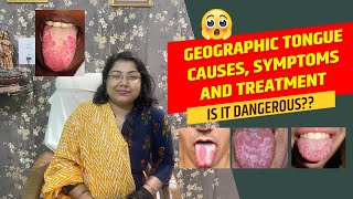 Is it dangerous Geographic tongue causes symptoms and treatment [upl. by Pascha]