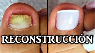 reconstruccion de uñas de pies con acrilico  nail reconstruction  reconstrução de unhas acrílico [upl. by Hsitirb]