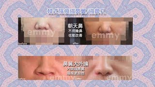 張宇正醫師 艾美整形診所－韓式隱痕縮鼻翼【內縮上提】效果大不同 [upl. by Onirefez]