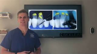 The best and easiest solution to closing tooth gaps Bioclear  Black triangles in teeth [upl. by Maye]