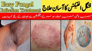 Fungal Infection Ka Asan Ilaj  Easy Fungal Infection Treatment  خراب ناخن کا علاج DrKashif Bilal [upl. by Mattland]