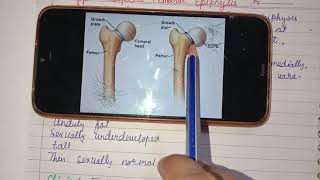 Slipped Capital Femoral Epiphysis [upl. by Kitarp327]