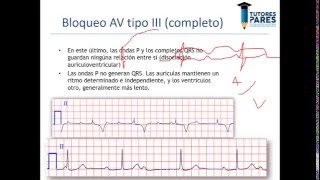 Arritmias en el electrocardiograma [upl. by Sucramd]