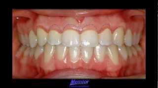 GingivoplastyGingivectomy [upl. by Paresh461]