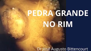 Como resolver a Pedra Grande de Rim [upl. by Atimed]