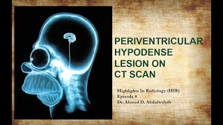 Periventricular hypodense lesions on CT scan Highlights In Radiology Episode 8 [upl. by Goldsworthy]