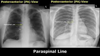 Normal Chest XRay Labelled Anatomy PA View Part 2 CXR Interpretation  Mediastinum Radiography [upl. by Llevra861]