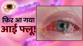 Eye Flu Preventions आई फ्लू से बचने का ये है आसान तरीका  Conjunctivitis [upl. by Nylhsa]