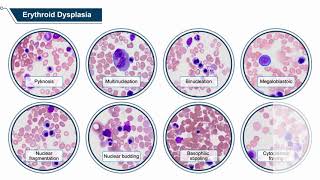 Secondary AML Through the Microscope A PathologyInformed Guide to Modern Diagnostic and Treatment [upl. by Ludmilla]