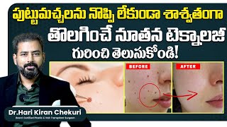 How to Remove Mole Permanently  Mole Removal Laser Treatment in Hyderabad  ReDefine Channel [upl. by Laeria]