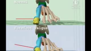 Comparison of Normal Gait to Forefoot Valgus Gait [upl. by Adialeda]