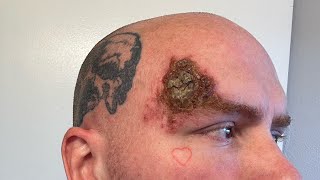 Week 6 Superficial Basal Cell Carcinoma Skin Cancer Aldara Treatment [upl. by Trautman407]