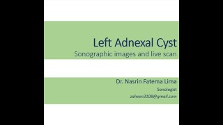 Sonographic view of Adnexal Cyst II Images amp live scan II Dr Nasrin Fatema [upl. by Seema125]