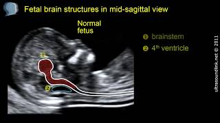 Open spina bifida at 1113 weeks gestation brainstem [upl. by Ttelrats]