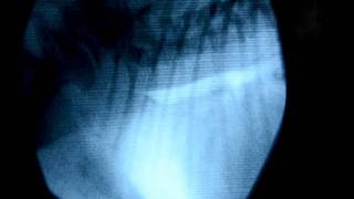 Colapso traqueal fluoroscopia y endoscopia [upl. by Oeniri]