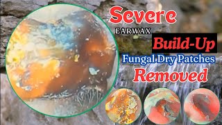 Severe Earwax BuildUp and Fungal Dry Patches Removed [upl. by Madelle]