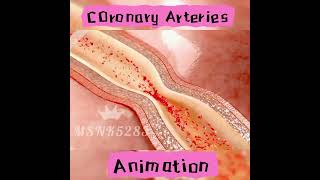 COronary Arteries stunting viralshort doctor hospitalsupplies [upl. by Hansiain]