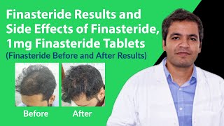 Finasteride Results and Finasteride Side Effects  Finasteride 1mg Tablets Before and After Results [upl. by Akkim]