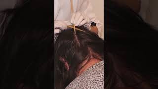 ASMR Examining Skin LESIONS on SCALP Real Person hair asmr short shorts [upl. by Renferd593]