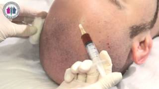 MESOTERAPIA MEDICA CAPILAR HD [upl. by Reine]