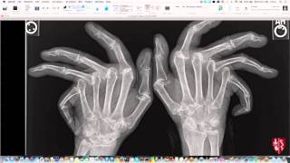 Introduction to Imaging of Arthritis [upl. by Alverson648]