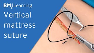 Vertical Mattress Suture  BMJ Learning [upl. by Oniram453]