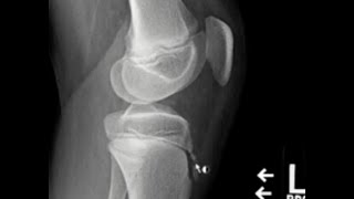 OsgoodSchlatter disease [upl. by Theobald]