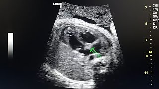 Right pulmonary aplasia in prenatal ultrasound [upl. by Tedmann]