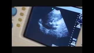 Sonosite 180 Plus Portable Ultrasound for Sale [upl. by Melena]