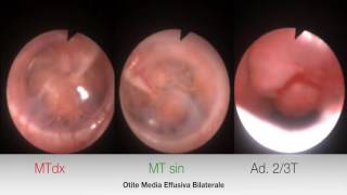 Otite media catarrale diagnosi endoscopica in paziente pediatrico [upl. by Fiden]