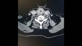 Recurrence of carcinoma after total thyroidectomy metastatic lymphadenopathy [upl. by Ttcos]