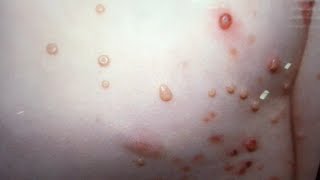 Molluscum Contagiosum PopTALK Dermatology diagnosis discussion [upl. by Eustasius]