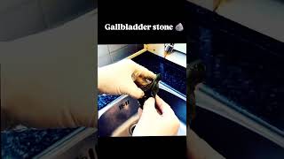 Gallbladder stone 🪨 [upl. by Oralia810]