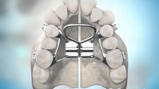 Surgically Assisted Palatal Expansion [upl. by Vidda172]