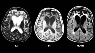 Picks Disease Frontotemporal Dementia  Pick Bodies [upl. by Mosby909]