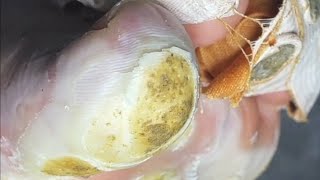 Pedicure video25，vertical plantaris，plantar wart [upl. by Jessamine638]