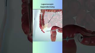 Appendectomy medical animation medicaleducation anatomy surgerysimulator [upl. by Trumann147]