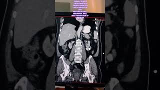 CHOLELITHIASIS HEPATOMEGALY PROSTATOMEGALY LEFT POSTEROLATERAL ABDOMINAL WALL HERNIATION of OMENTUM [upl. by Kaazi]